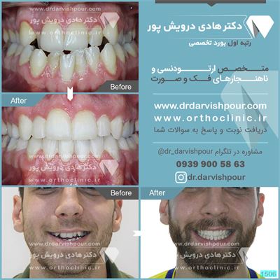 درمان ارتودنسی ثابت دو فک همراه با کشیدن دندان