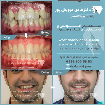 ارتودنسی ثابت همراه با کشیدن دندان جهت اصلاح نامنظمی